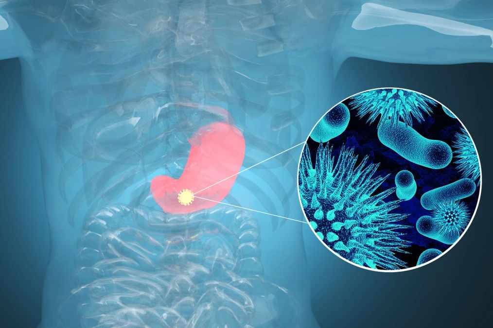 肿瘤标记物CA72-4：“胃”，你还好吗？